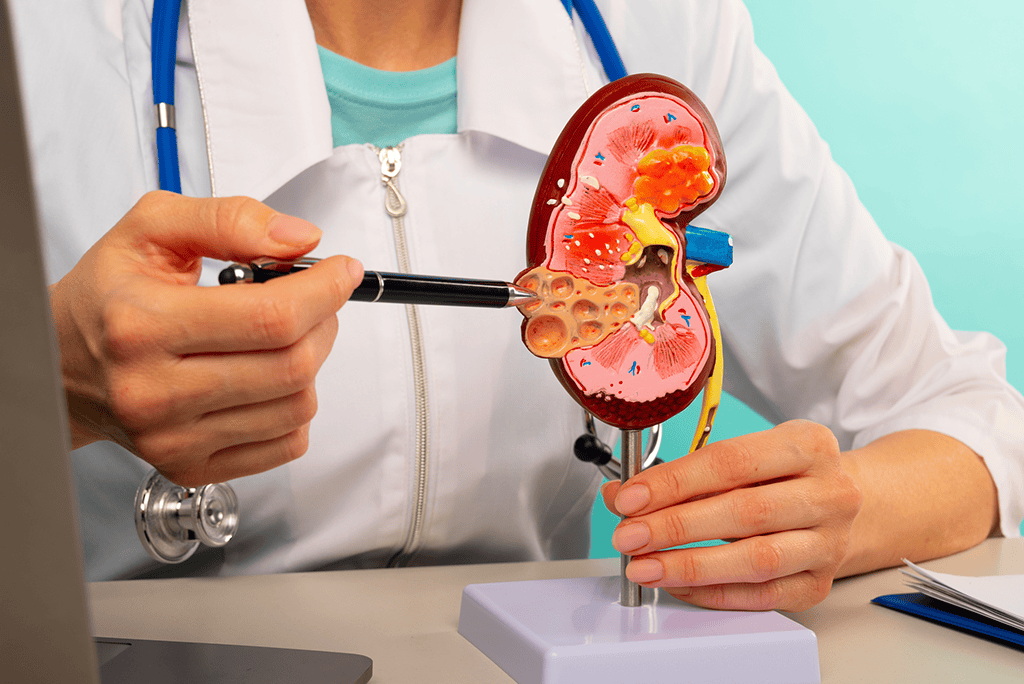 LUPUS and KIDNEY DISEASE